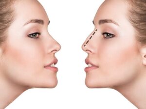 Rhinoplasty in Dubai(تجميل الأنف في دبي)