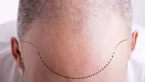 Hair transplant in Dubai