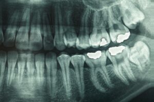 Panoramic Dental X-Ray Cost in Dubai