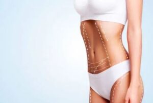 liposuction surgery