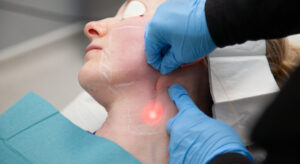 Endolift
