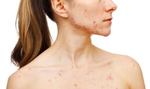Is Acne Treatment Safe for Pregnant Women?
