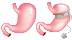 Gastric Balloon Placement
