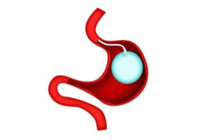 Gastric Balloon Placement