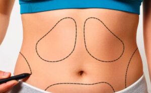 liposuction surgery