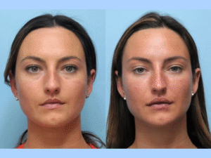 The Art of Beauty at the Best Aesthetic Clinic in Dubai for Thread Lift