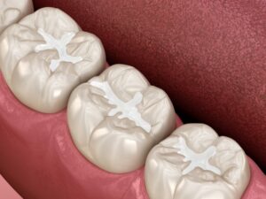 Tooth Filling