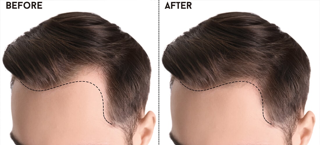 Best Hair Transplant in Islamabad