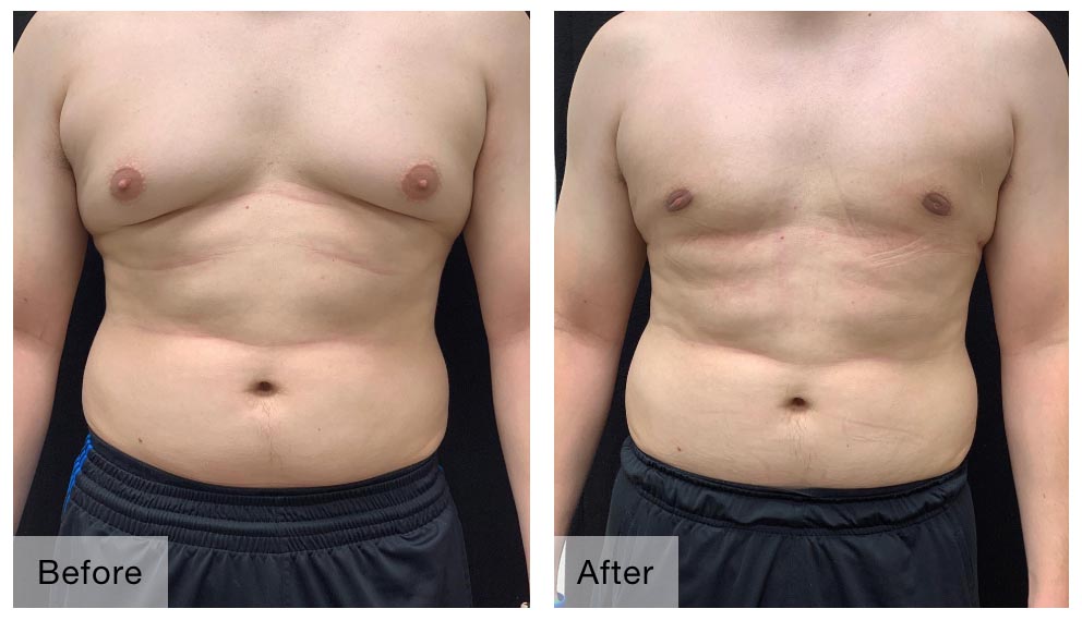 gynecomastia in dubai