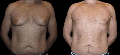 before and after male breast reduction photos,