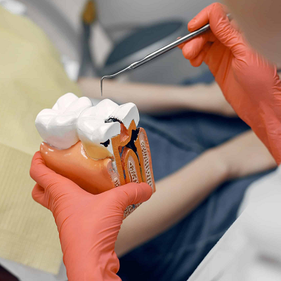 Root Canal Durability: How Many Years Can You Expect?