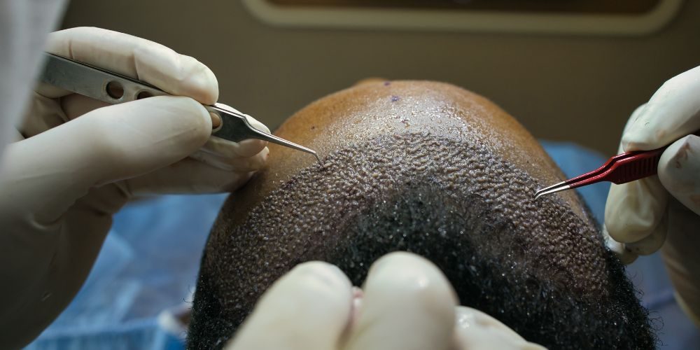 best hair transplant in lahore