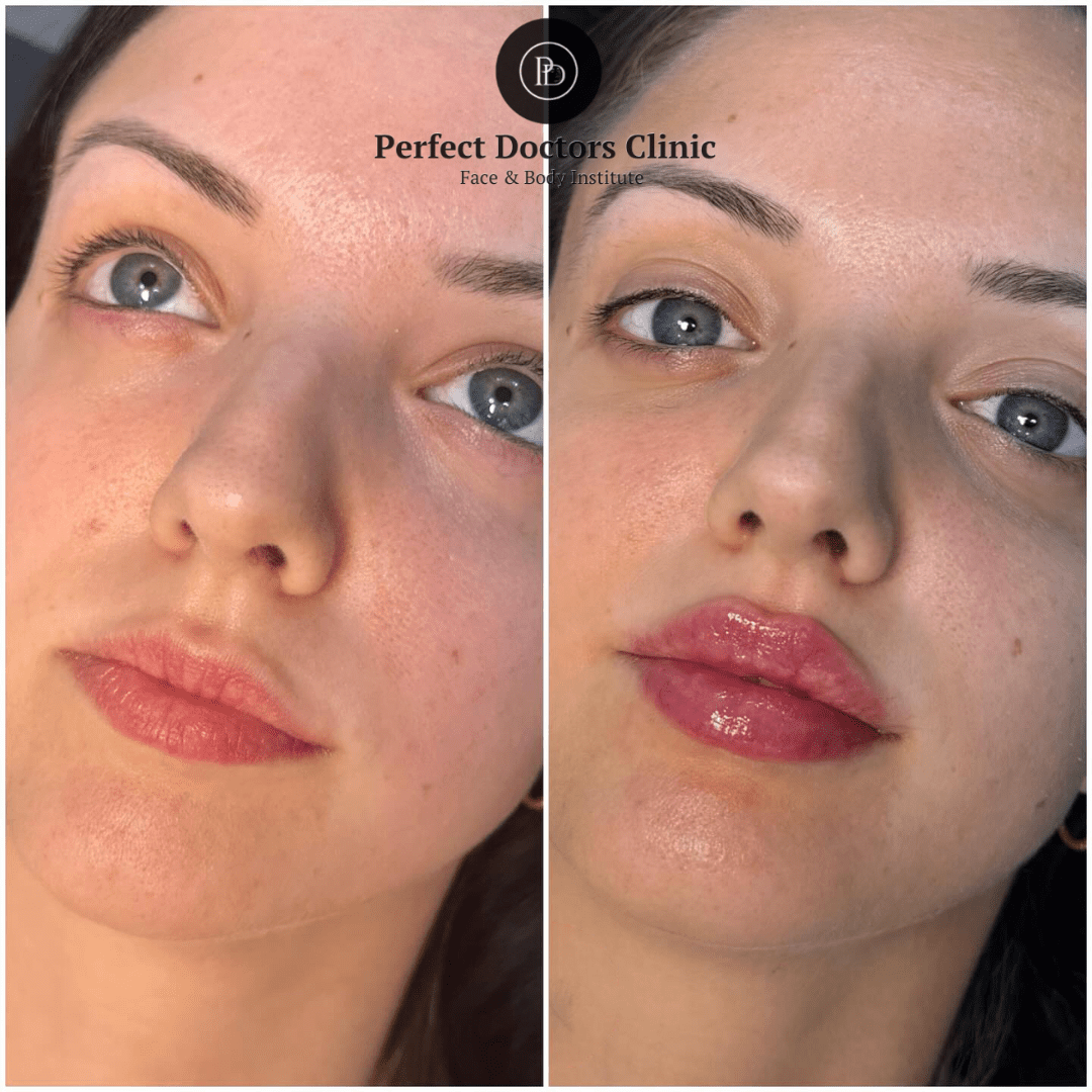 Juvederm fillers