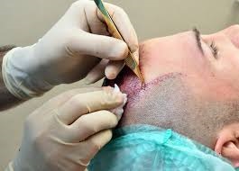 Hair Transplant in Riyadh