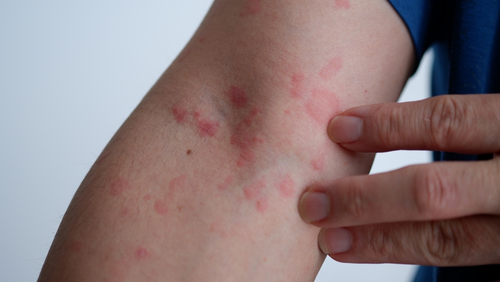 Treatment for papular eczema