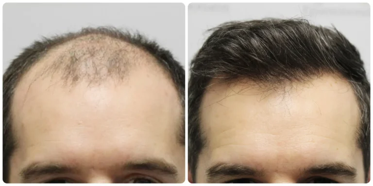 best hair transplant in lahore