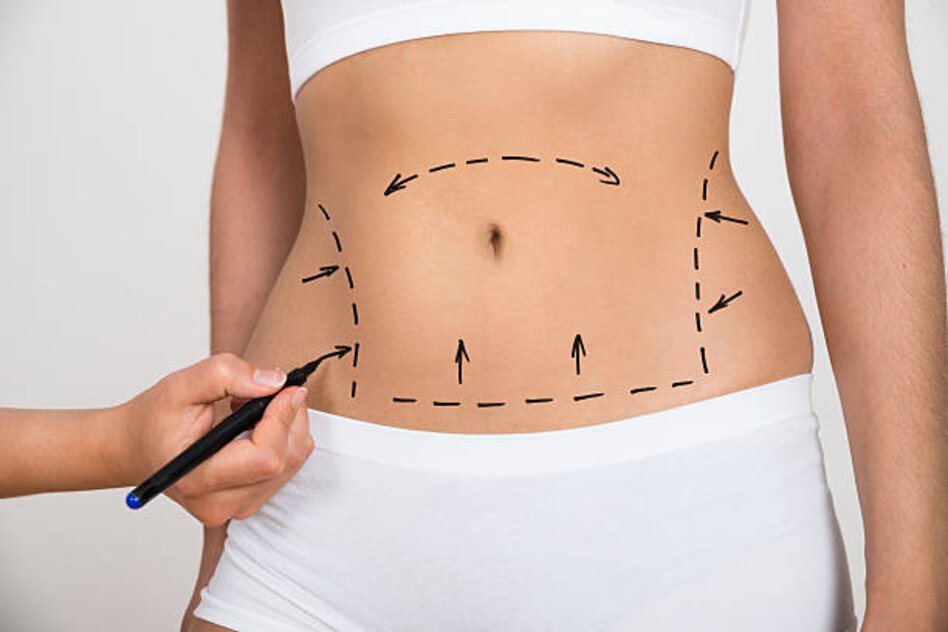 Transform Your Body: Liposuction Surgery in Dubai