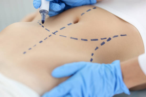 Liposuction Surgery in Dubai: Essential Insights for Patients