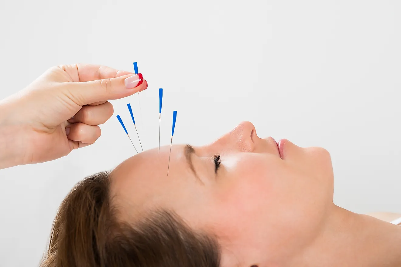 Chinese Acupuncture