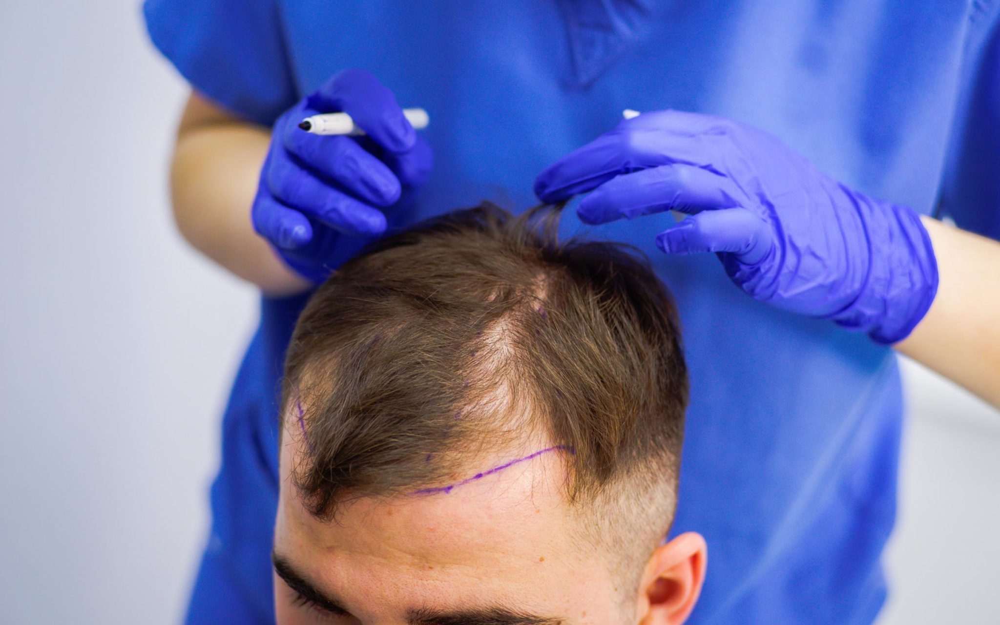 تكلفة زراعة الشعر