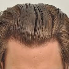 Hair Transplant Cost in Riyadh