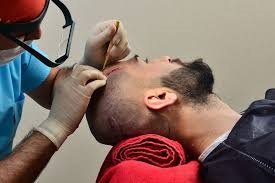 The Rising Trend of Hair Transplants in Riyadh