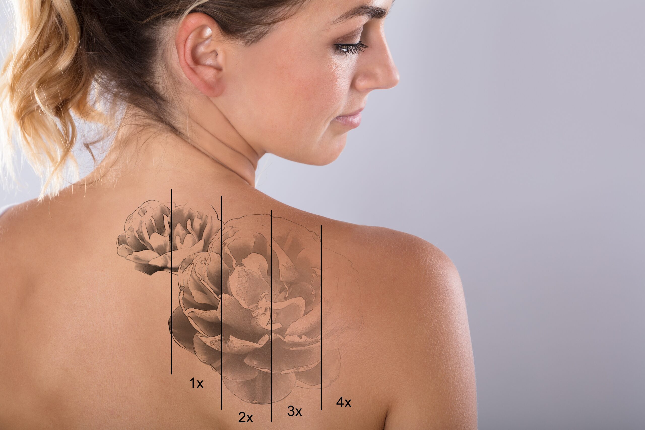 How Does Skin Type Affect Laser Tattoo Removal?