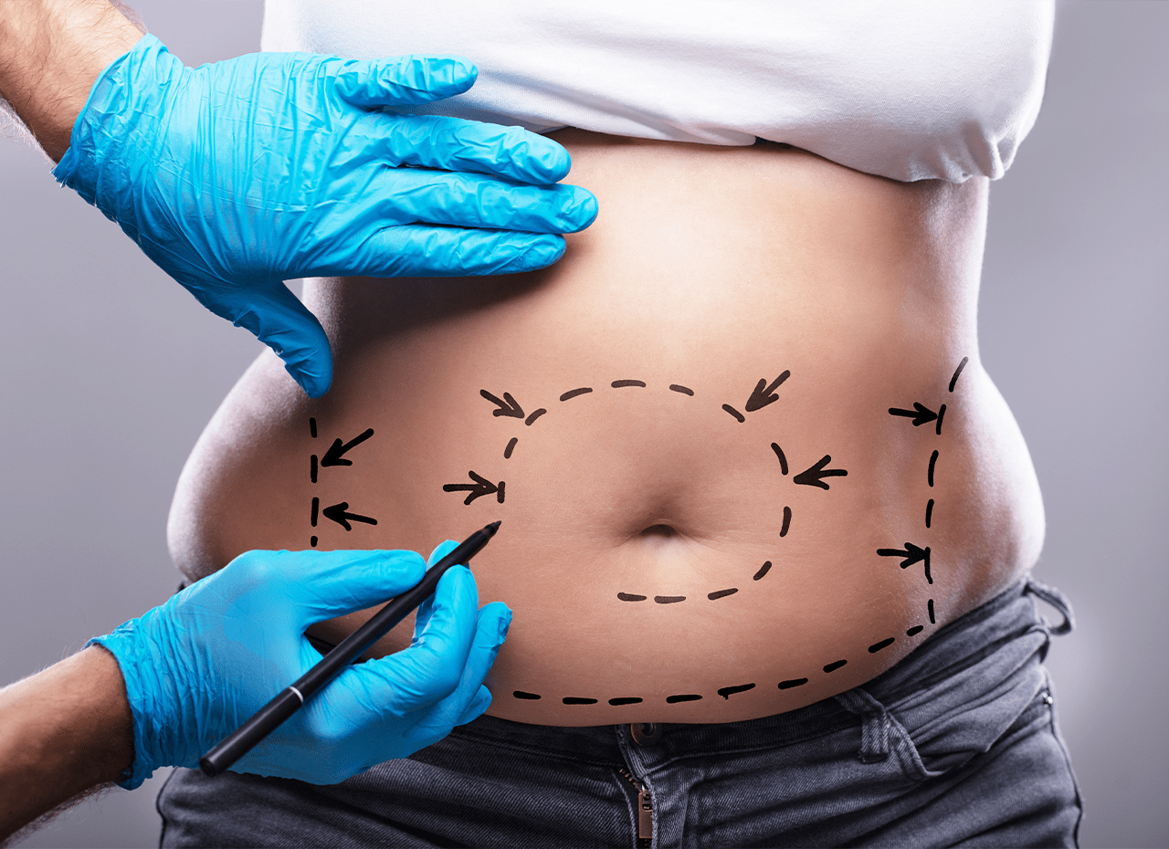 Liposuction Surgery in Dubai: Costs and Recovery