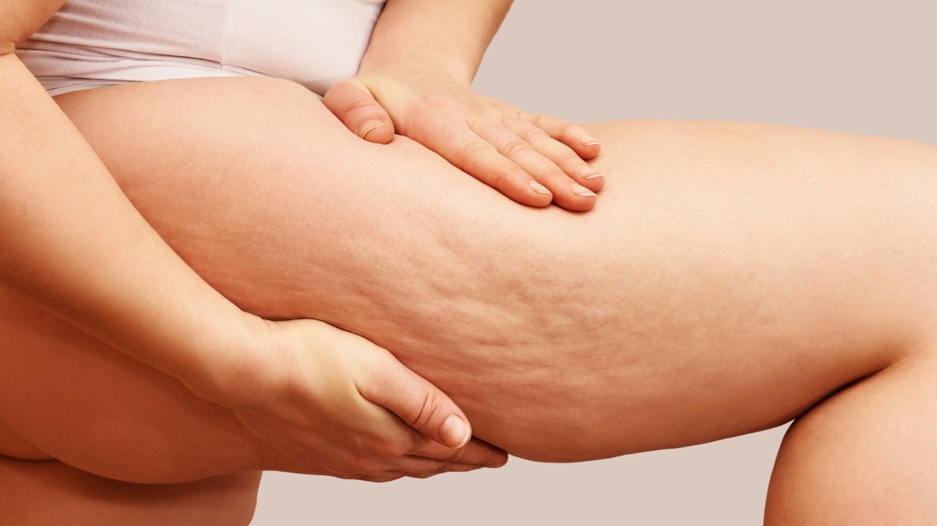 What to Expect from NYC Cellulite Treatment Services