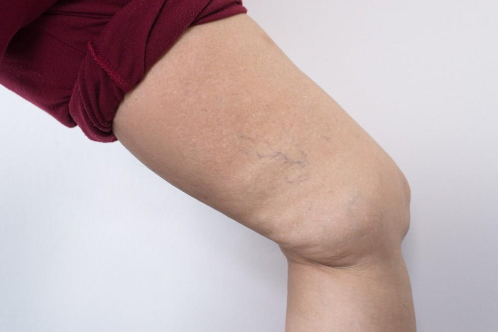 Spider Veins Treatment in Abu Dhabi Smooth Legs Await