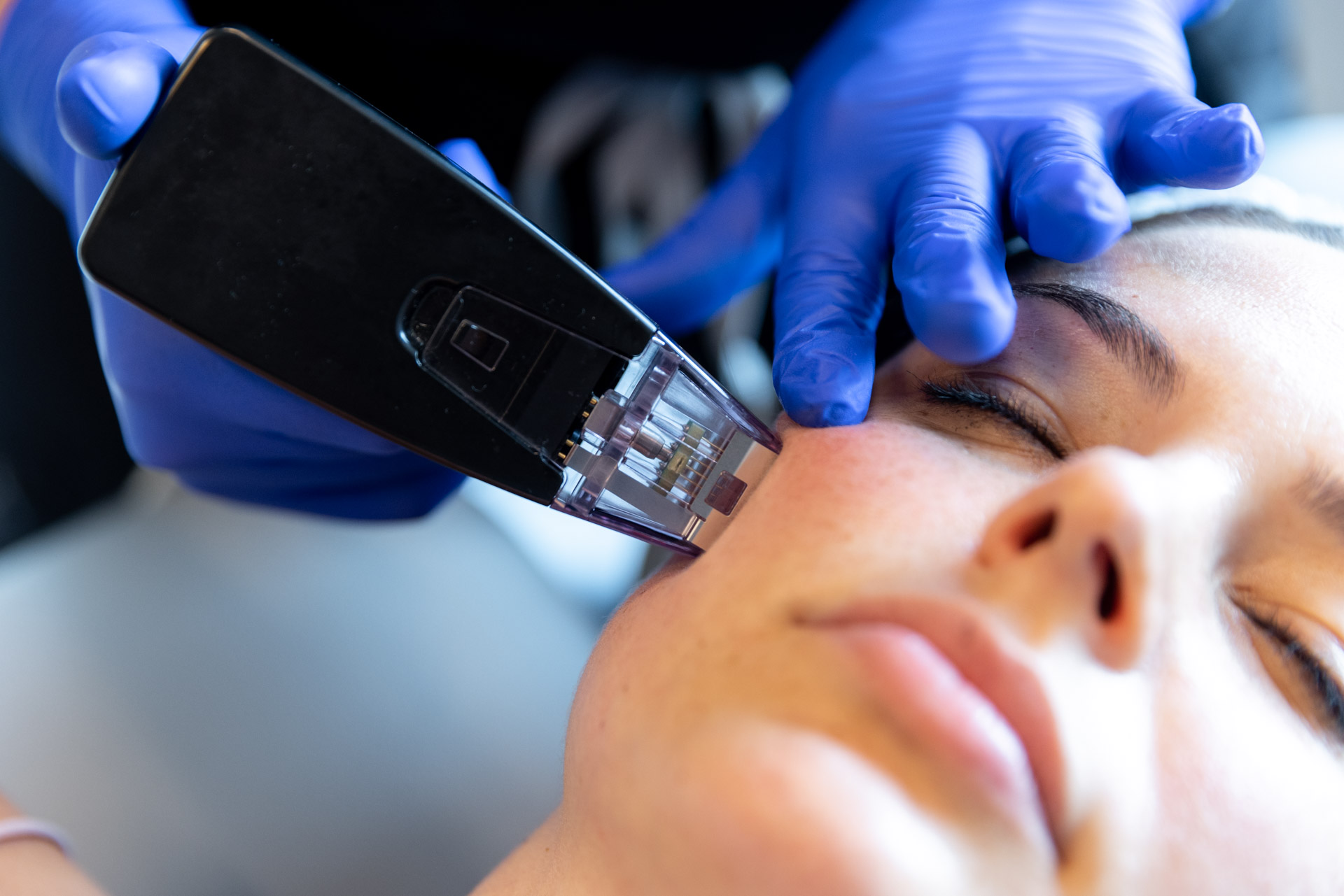 Morpheus8 RF Microneedling: The Ultimate Guide to Skin Rejuvenation