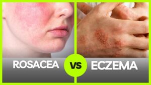 rosacea vs eczema