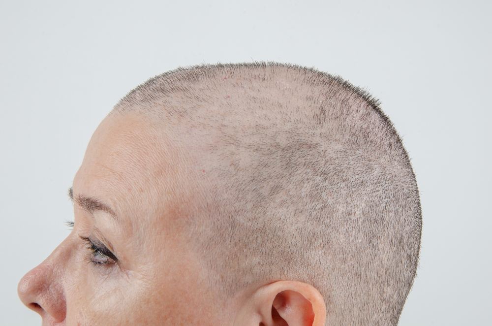 types of skin cancer on the scalp