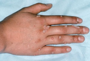 How to Choose the Best Dermatologist for Warts Removal in Islamabad