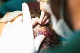 Hair Transplant in Riyadh