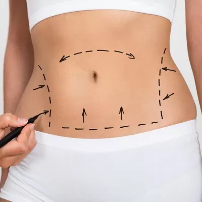 What to Expect During Full Body Liposuction Surgery in Dubai