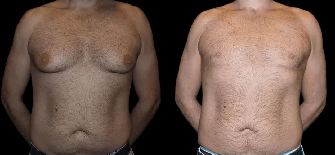 Best Gynecomastia Surgeons in Dubai