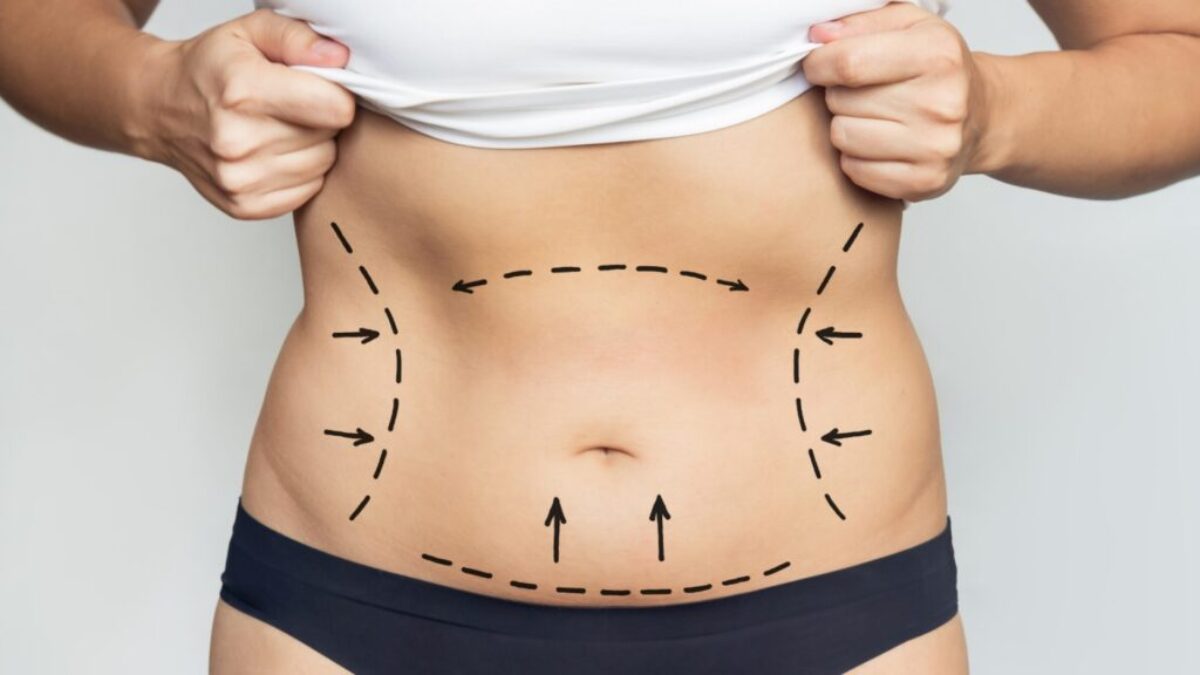 The Role of Diet and Exercise in Full Body Liposuction in Dubai Success