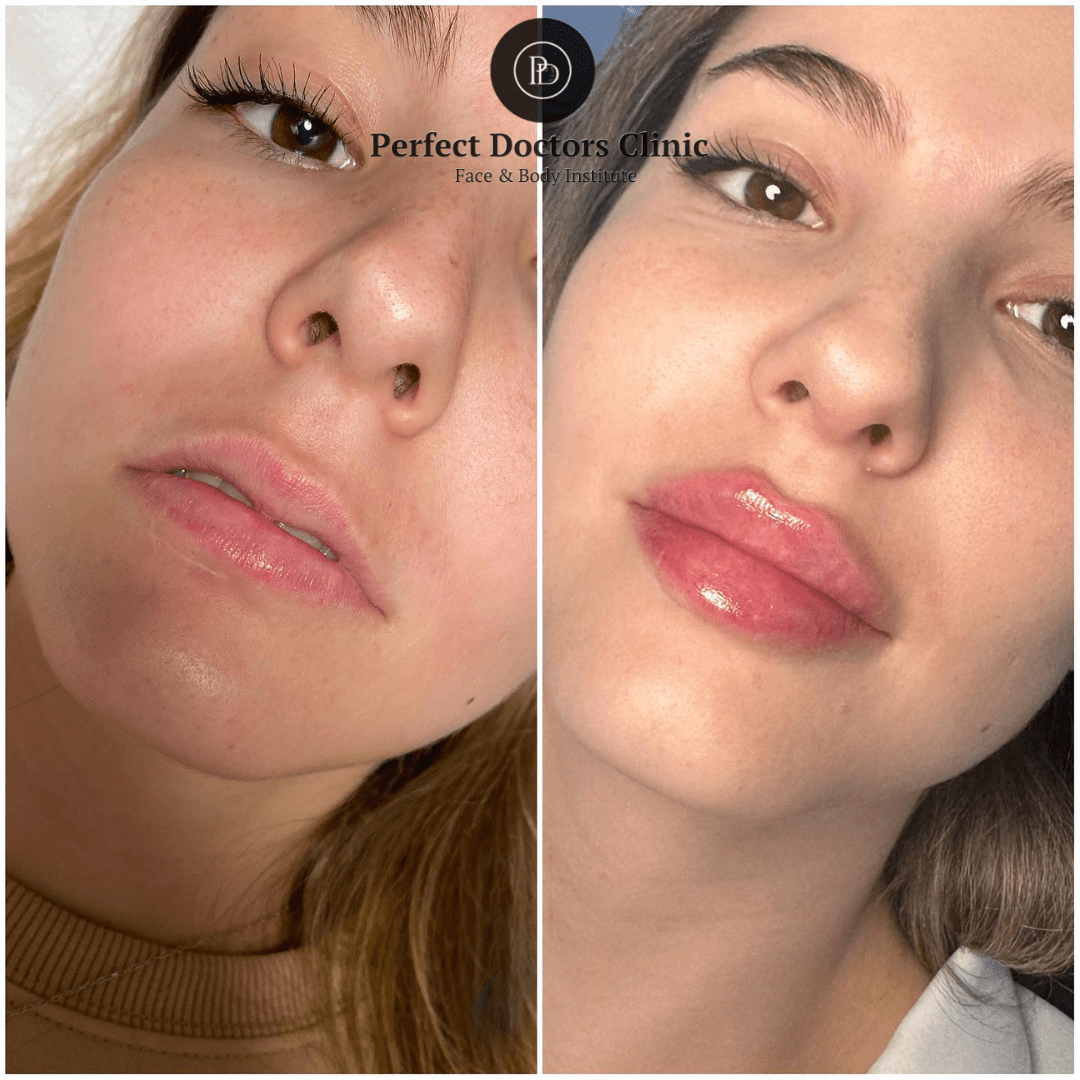 The Juvederm Journey: From Consultation to Results at the Best Aesthetic Clinics in dubai