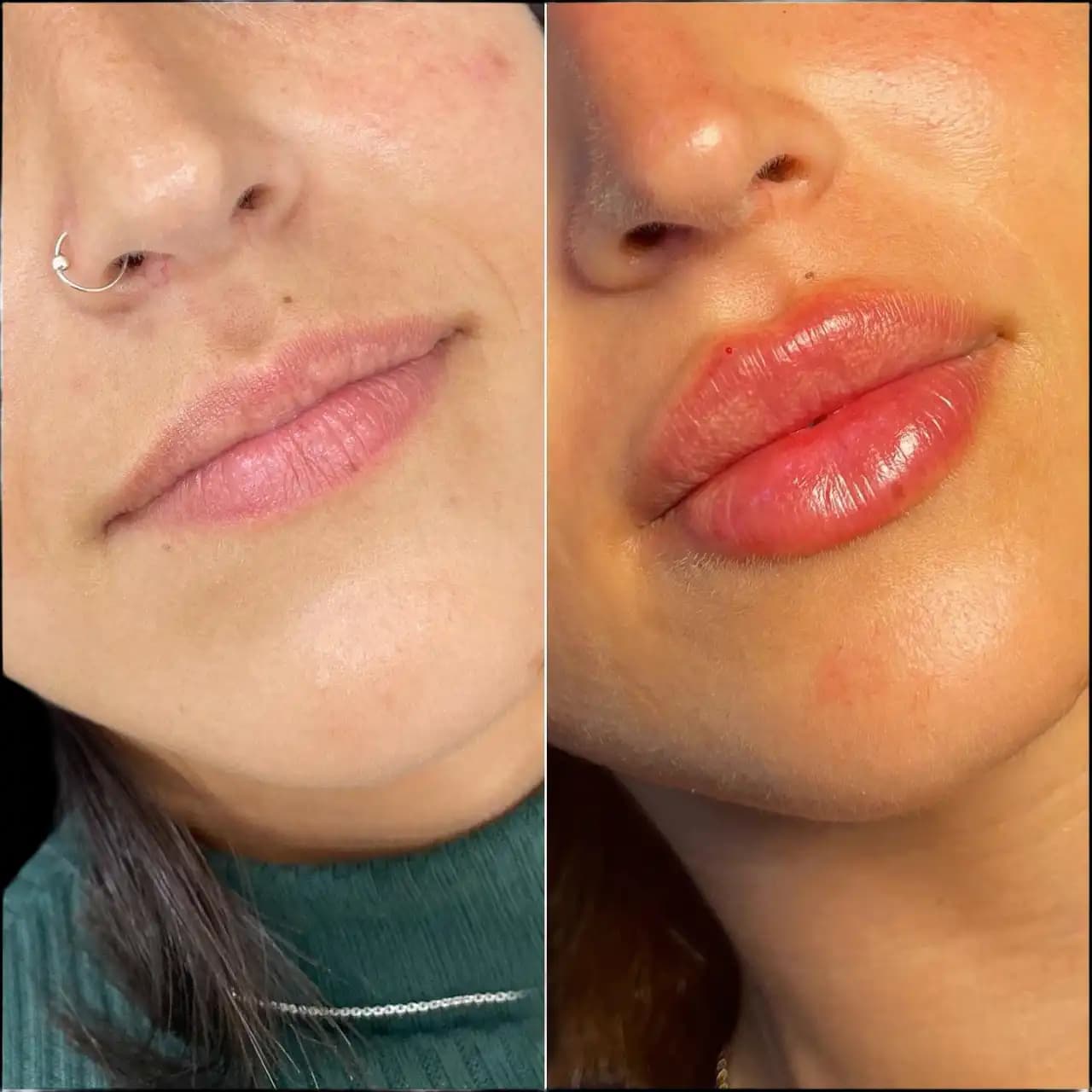 Lip Fillers in Dubai: What to Know Before You Go