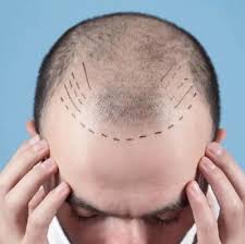 Regain Your Confidence with a Hair Transplant in Riyadh