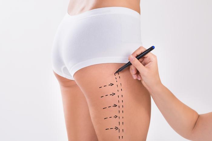 Liposuction in Dubai