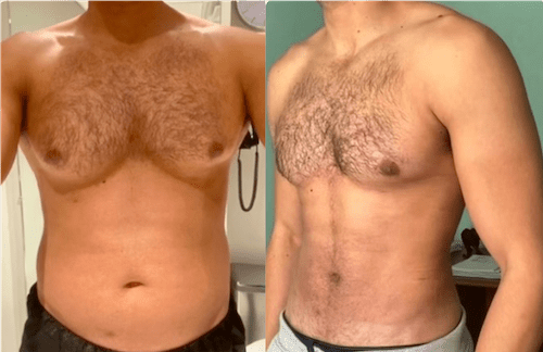 Best Gynecomastia Surgeon in Dubai