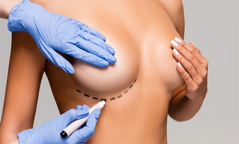 Breast Lift Surgery in dubai: What to Expect