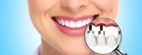 dental implants Alexandria