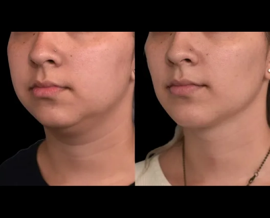 Double chin removal in Dubai: Get the Look You Desire