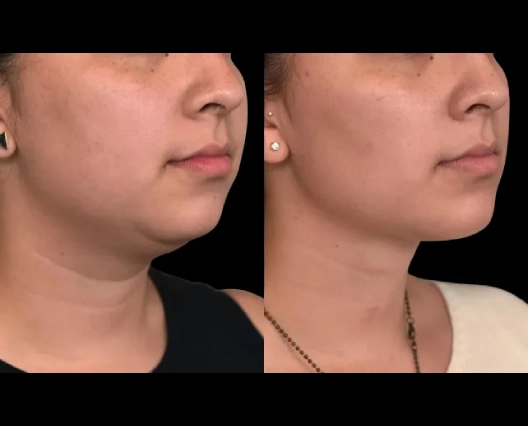 Best Double chin removal Surgeon in dubai: A Comprehensive Approach to Chin Contouring