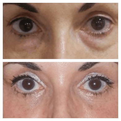 Eye Bag Removal Options for All Ages: Insights from the Best Doctors in Dubai