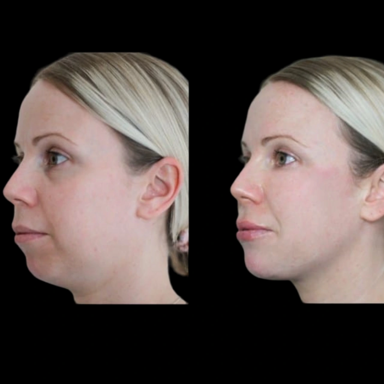 chin fillers treatment in dubai