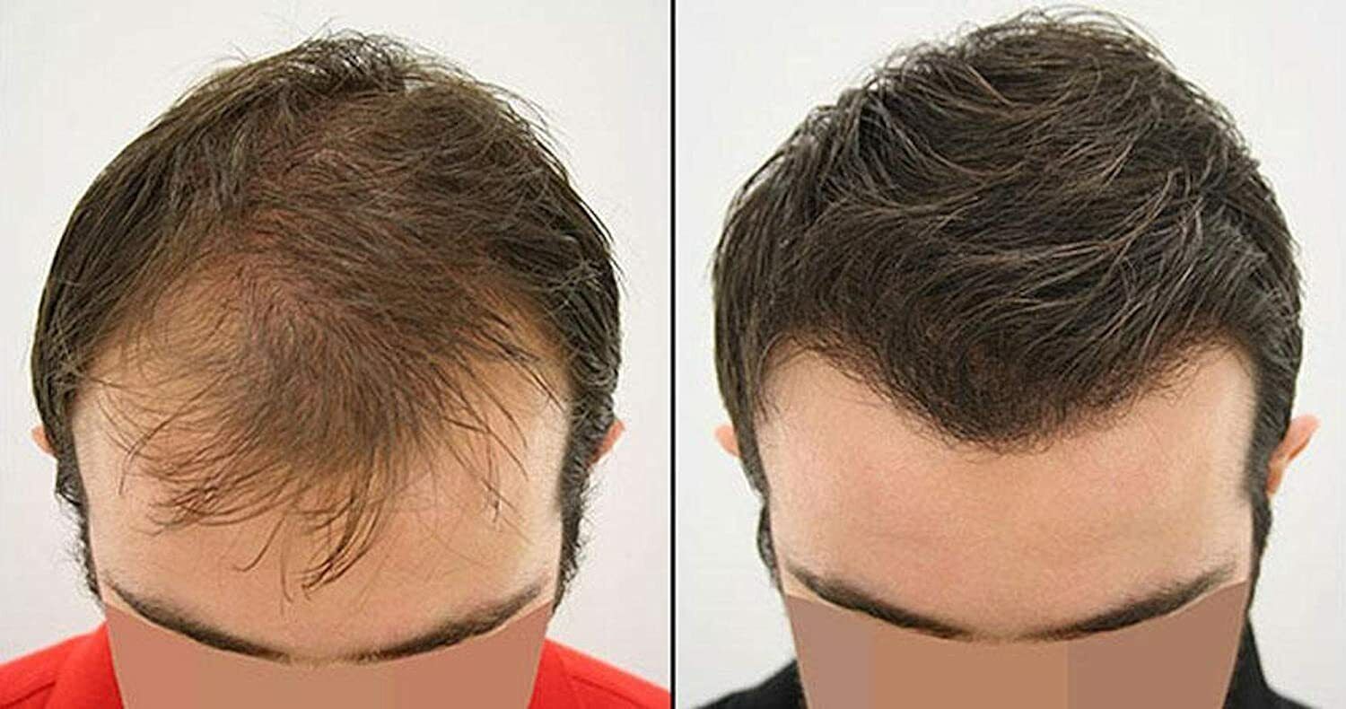 Hair Transplant in Dubai